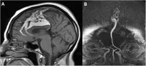 A. Imagen de RM en secuencia T1 sin contraste. La lesión se comporta como hiperseñal compatible con contenido graso; se aprecia agenesia del esplenio del cuerpo calloso y drenaje venoso prominente. B. Angio-RM cerebral en la que se aprecia un tronco arterial único distal a la arteria comunicante anterior, compatible con anomalía tipo ácigos.