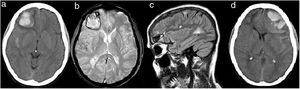 (a) CT brain (2014) showing right frontal hemorrhage and subarachnoid hemorrhage around temporal lobe. (b) Gradient Echo T2 sequence one month later showing hypointense signal around temporal lobe due to subarachnoid hemorrhage and around right frontal hemorrhage. No hypointense signals suggestive of microbleeds are showed. (c) High signal lesions on axial FLAIR-T2 sequence one month later showing juxtacortical and periventricular lesions suggestive of MS diagnosis. (d) CT brain (2019) showing left frontal hemorrhage, subarachnoid hemorrhage around frontal and temporal lobe, and mass effect.