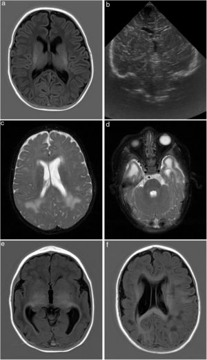 Hallazgos de neuroimagen correspondientes a cada estadio de la escala de Noyola et al. modificada: a y b) Corte axial T1 de la RM cerebral y ecografía transfontanelar del paciente de 43 días de vida, clasificado como grado 1 en la escala de Noyola modificada: se objetiva la presencia de un quiste germinolítico de 6mm en el surco talamocaudado izquierdo, así como ventriculomegalia leve del ventrículo lateral izquierdo; c y d) RM cerebral, corte axial T2. Paciente de 2 meses de vida, clasificado como grado 2. Encefalopatía multiquística; e) RM cerebral, corte axial T1. Paciente de 4 meses de vida, clasificado como grado 3 en la escala de Noyola modificada. Extensa pérdida de la diferenciación corticosubcortical de la sustancia gris cortical perisilviana. Hipoplasia del cuerpo calloso. Anomalías de la migración neuronal y/o heterotopia en banda. Aumento de señal de la sustancia blanca subcortical de ambos polos temporales por gliosis o malacia. Ventrículos en el límite alto de la normalidad, y f) RM cerebral, corte axial secuencia FLAIR. Paciente de 6 meses, clasificado como grado de 3 en la escala de Noyola modificada. Alteración parcheada de la señal de la sustancia blanca de ambos hemisferios y asimetría hemisférica con menor tamaño de hemisferio derecho y ventriculomegalia asociada. Pérdida de la diferenciación córtico-subcortical y aumento de la sulcación compatible con polimicrogiria.