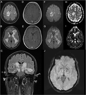 RM cerebral con contraste; cortes axiales A-B, D-J) y coronal C). Se aprecian múltiples lesiones parenquimatosas pseudonodulares en ambos hemisferios cerebrales, hiperintensas en las secuencias FLAIR A-C), afectando la sustancia blanca principalmente periventricular y yuxtacortical del giro precentral derecho, así como los ganglios de la base y las cápsulas internas, con extensión caudal a los pedúnculos cerebrales del mesencéfalo. No presentan edema ni ejercen un efecto de masa significativos. Algunas de ellas realzan discretamente en la periferia en forma de anillo semiabierto tras la administración de gadolinio D-E) y presentan discreta restricción de la difusión periférica –diffusion weighted imaging (DWI): F-G); apparent diffusion coefficient (ADC): H-I)–. Las lesiones más profundas contienen focos petequiales en las secuencias de susceptibilidad magnética (susceptibility weighted imaging [SWI]: J).