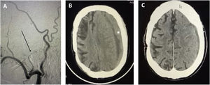 Caso tipo de paciente de edad avanzada con elevado índice de comorbilidad (índice Charlson>2, historia previa de infarto de arteria cerebral media) y riesgo anestésico. El paciente fue sometido a embolización con coils de arteria meníngea media y polivinil-alcohol de ramas distales (flecha, A). Tomografía preoperatoria tras fracaso del tratamiento quirúrgico mostrando hematoma subdural de 20mm, efecto masa y desplazamiento significativo de línea media (>5mm) (asterisco, B). Resultado tomográfico a las 4 semanas del tratamiento endovascular; muestra resolución completa del hematoma (C). El paciente fue capaz de resumir su actividad funcional previa al desarrollo del hematoma subdural crónico (escala modificada de Rankin 2).