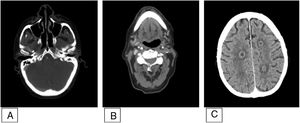 TC cráneo-cervical con contraste. A) Ocupación de oído medio izquierdo compatible con otitis con ausencia de neumatización de celdillas mastoideas homolaterales. B) Oclusión de ACI izquierda y vena yugular interna ipsilateral. C) Imágenes hipodensas en varios territorios con captación de contraste en anillo compatibles con abscesos. ACI: arteria carótida interna;TC: tomografía computarizada.