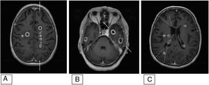 RNM cerebral. Secuencias volumétricas ponderadas en T1 para neuronavegador tras administración de contraste. Cortes axiales. Puede observarse una distribución de los abscesos en los territorios frontera. A) Entre ACM izquierda (lateral a las marcas) y ACA izquierda (medial a las marcas). B) Entre ACM izquierda (rostral a marcas) y ACP izquierda (caudal a marcas). C) Territorios frontera corticales anterior y posterior (líneas) y en zona de perforantes de ACM derecha (flecha). Imágenes basadas en territorios vasculares de Tatu et al.9 y territorios frontera de Caplan10. ACA: arteria cerebral anterior; ACI: arteria carótida interna; ACM: arteria cerebral media; ACP: arteria cerebral posterior; RNM: resonancia nuclear magnética.