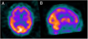 SPECT cerebral tras administración de HMPAO-Tc99m, se muestra corte transaxial (A) y sagital (B). Se observa una hipoperfusión frontal bilateral, así como frontal y parietal izquierdas, compatibles con un patrón de demencia frontotemporal.