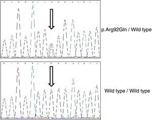 El estudio del gen TNFRSF1A revela un genotipo heterocigoto sencillo para la variante p.Arg92Gln.