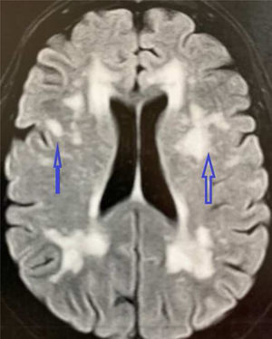 MRI legend: Multiple nodular images, some confluent, with hypersignal in the FLAIR and T2, without restriction in the diffusion of water, observed in the periventricular white substance, semioval centers and radiated crowns, in the external capsule bilaterally, in the insula lobes and in the anterior portions of the temporal lobes associated with multiple small old infarctions observed in the radiated heart of the right frontal lobe, in the knee and trunk of the corpus callosum and in the white pericalosal substance bilaterally.