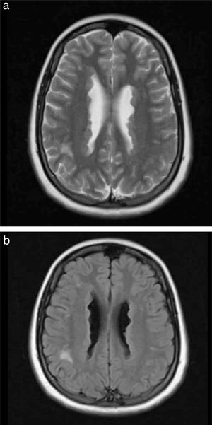 a) Corte axial potenciado en T2. b) Corte axial potenciado en T2-flair con evidencia de HNPV. (Imágenes pertenecientes a la paciente).