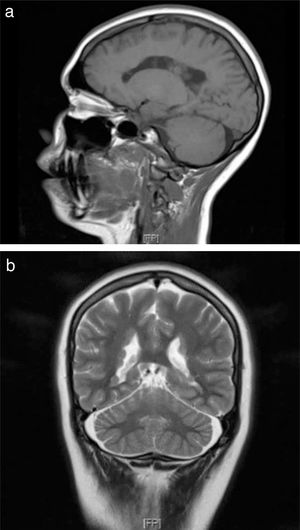 a) Corte sagital potenciado en T1 (imagen perteneciente a la hija). b) Corte coronal potenciado en T2 con evidencia de hipointensidad que genera irregularidad a nivel de bordes externos de ventrículos laterales por heterotopia nodular periventricular (HNPV) (imagen perteneciente a la madre).