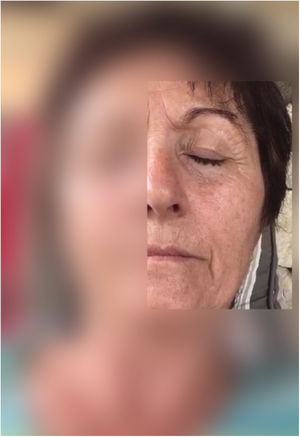 Clínica de la paciente. Espasmo hemifacial izquierdo con elevación de ceja ipsilateral y contracción leve de músculo orbicularis oculi así como levator anguli oris y mentalis, apreciándose leve asimetría en el surco facial.