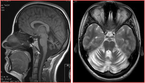 Estudio de RM-T1 (sagital) y T2 (axial) del paciente I: 1: se observa atrofia difusa del cerebelo con morfología normal del tronco cerebral y sin lesiones de sustancia blanca.