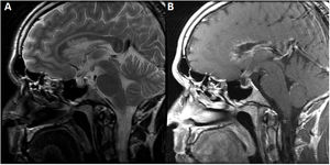 Imágenes de la RM de cráneo. A) En la secuencia FSE T2 en plano sagital se evidencia una disminución global del tamaño de la hipófisis para la edad del paciente. También es visible una hiperintensidad de señal periventricular de aspecto algodonoso en la rodilla y cuerpo del cuerpo calloso. B) En la secuencia FSE T1 poscontraste intravenoso en el mismo plano, se identifica realce de aspecto pseudonodular ependimario en la región de las astas frontales con extensión hacia el cuerpo calloso coincidiendo con el área de alteración de señal en T2, realce de aspecto liso en el IV ventrículo y región superior del tallo hipofisario. No se aprecia lesión o realce patológico en la glándula pineal.