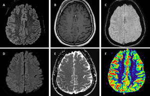 Brain 1.5T MRI of FLAIR-hyperintense Lesion in Anti-MOG-associated Encephalitis with Seizures. T2-fluid attenuated inversion recovery (FLAIR) imaging showing right parietal cortical gyri and some sulci hyperintensity and swelling without involvement of adjacent juxta-cortical white matter (A). Axial T1-weighted post-gadolinium imaging shows right parietal leptomeningeal enhancement (B). Axial susceptibility weighted imaging shows hyperintense vessels in the same region due to decreased oxygen extraction secondary to hyperperfusion (C) confirmed by perfusion imaging sequences (F). Diffusion restriction in posterior parietal gyri (D,E).