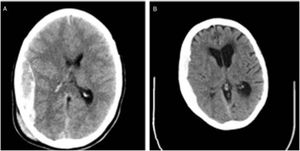 A) Imagen de TC craneal de paciente de 35años que muestra hematoma epidural frontoparietal derecho. B)Imagen de TC craneal de paciente de 76años que muestra hematoma subdural agudo frontoparietotemporal derecho.