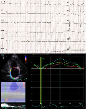 Electrocardiograma basal compatible con bloqueo interauricular avanzado (A). Ecocardiograma que muestra dilatación auricular y pico de strain auricular longitudinal deprimido (B).