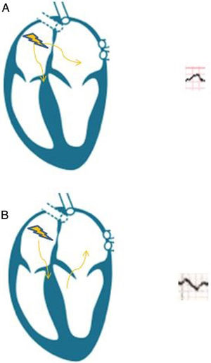 Activación auricular en sujetos sanos (A) y en pacientes con bloqueo interauricular (B).