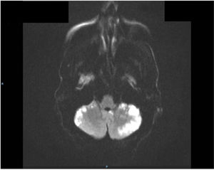 Imagen de resonancia magnética. Corte axial secuencia difusión que muestra infartos agudos en hemisferios cerebelosos.