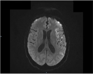 Imagen de resonancia magnética. Corte axial secuencia difusión con ictus corticales hemisféricos bilaterales de predominio izquierdo.