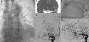 a) Radiografía de tórax en proyección posteroanterior (PA) tras implantación de la segunda prótesis valvular, con la primera estabilizada en el cayado aórtico (estrella); b) Angio-TC de polígono de Willis, reconstrucción coronal de proyección de máxima intensidad de contraste con defecto de repleción en segmento M1 de ACM derecha (flecha); c) Proyección PA de angiografía por sustracción digital (ASD) que confirmó la oclusión de la ACM derecha (flecha hueca); d) Adquisición PA de fluoroscopia con doble stentriever en Y posicionado en la bifurcación de la ACM; e) ASD PA final que demostró recanalización completa de la ACM derecha.