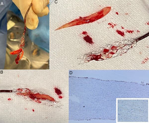 a-c) Émbolo extraído con apariencia de fragmento tisular biológico sólido; d) La tinción con marcador CD31 humano fue negativa, lo que sugiere correspondencia a pericardio bovino procedente de la primera bioprótesis- MedtronicEvolutPro#29 (Medtronic, Fridley, Minnesota, EE. UU.).