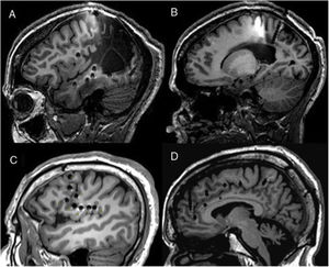 Ejemplos de diferentes abordajes que muestran cómo la E-EEG permite explorar regiones extratemporales de difícil acceso a otras técnicas como los electrodos subdurales. A y B) Exploración en un paciente con una lesión porencefálica extensa donde se explora estructuras neocorticales y mediales. C) Exploración perirolándica e insular en un paciente con RM negativa. D) Exploración frontal medial empleando un abordaje ortogonal y oblicuo.