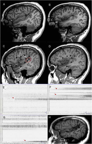 Paciente con epilepsia focal en relación con una polimicrogiria perisilviana derecha extensa. A y B) Secuencia T1 sagital que muestra la extensión de la malformación, con afectación profunda a nivel de la ínsula y de los opérculos. C y D) Abordaje extenso con electrodos profundos que permiten explorar la corteza en diferentes planos, incluyendo la ínsula. E) La crisis comienza en la parte posterior del giro temporal superior (círculo en blanco en C). F) Evolución sobre corteza temporal e ínsula posterior. G) Evolución al hipocampo. H) Secuencia T1 sagital que muestra cómo una resección limitada en el giro temporal superior puede conseguir el control de la epilepsia en este paciente, pese a presentar una lesión más extensa.