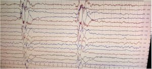 Electroencephalogram revealing Radermecker complexes (high-voltage periodic repetitive polyphasic sharps and slow wave complexes of 0.5- to 2-second duration that recur every 4–15 seconds).