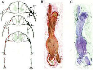 Reproducción con mínimas modificaciones de las figuras 65 a 67 en el trabajo de Krücke12. A)Diagrama de la topografía lesional en el SGB (de arriba abajo, niveles cervical, dorsal y lumbar). Las lesiones (punteados rojos) recaen en los troncos nerviosos proximales, que incluyen raíces raquídeas ventrales y dorsales, ganglios raquídeos, ganglios simpáticos y ramos ventrales de los nervios espinales. Hemos mantenido las indicaciones b-c que el autor utilizó para señalar la localización de sus figuras 65, 66 (aquí 1B,C) y 67 (aquí no reproducida). B)Sección longitudinal de un segmento de nervio entre la raíz raquídea ventral y el nervio espinal, procedente de un paciente con SGB fallecido el día 18 de curso clínico. Hemos mantenido la numeración original. 1 y 2: áreas ilustradas por Krücke en otras figuras demostrando un extenso «edema endoneural mucoide» (entiéndase inflamatorio); 3: ramos del nervio espinal (indudablemente, ramo ventral y ramo dorsal); 4: dilatación fusiforme del nervio espinal; 5: ganglio raquídeo, y 6: raíz raquídea anterior (Van Gieson, aumento no especificado). C)Otra sección longitudinal al mismo nivel en la que se observa una coloración púrpura de la dilatación fusiforme del nervio espinal (cresil violeta).