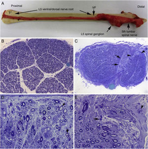 Hallazgos histológicos en un caso fatal de AIDP15. A)Aspecto macroscópico de L5 desde su arranque proximal hasta su entrada en el foramen vertebral (VF); la disección continúa después sin interrupción para mostrar el ensanchamiento ganglionar y el quinto nervio lumbar. Hay un engrosamiento nervioso a partir del foramen vertebral (compárese con la figura 1B, C). B)En esta sección semifina de la raíz ventral L5, a 1cm de su entrada en el foramen vertebral, se observa que la densidad de fibras mielínicas está preservada (azul de toluidina; ×100 antes de reducción). C)En esta sección semifina del ramo ventral del quinto nervio lumbar, a nivel de su emergencia foraminal, se observa edema endoneural difuso, que es más acentuado en ciertas áreas subperineurales (puntas de flecha) o en una de las regiones adyacentes al tabique peri-endoneural (flechas); el edema endoneural produce un efecto de espaciamiento de las fibras mielínicas, de manera que su densidad parece reducida en comparación con la imagen anterior (azul de toluidina; ×65 antes de reducción). D)Detalle de la zona yuxta-tabique indicada con flechas en C, que demuestra la presencia de edema inflamatorio con numerosas células mononucleares y fibras aisladas con envoltura mielínica fina para el diámetro axonal (punta de flecha) o con degeneración vacuolar de la mielina (flecha) (azul de toluidina; ×630 antes de reducción). E)Detalle del área subperineural, indicada con puntas de flecha, donde se observa un marcado edema con presencia de células inflamatorias tanto endoneurales (flecha) como epineurales (punta de flecha) (azul de toluidina; ×630 antes de reducción).
