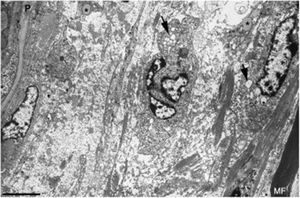 Imagen ultraestructual de la región superineural de la figura 2E. Hay un marcado edema endoneural con material amorfo, probablemente proteoglicano, y haces dispersos de fibrillas de colágeno. Nótese la presencia de macrófagos que contienen gotas lipídicas (asteriscos), así como numerosas vesículas de endocitosis (flechas) y lisosomas. En el área edematosa no hay fibras mielinizadas; la única observada (MF) se sitúa a 20μm del perineuro (P) (barra, 3μm).