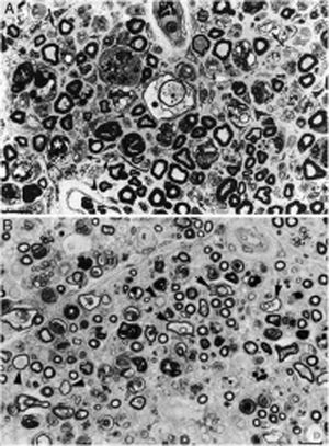 Composición de la figura 3 de Berciano et al.38 (A) y de la figura 2 de Feasby et al.37 (B), ambas correspondientes a secciones semifinas transversas de raíces raquídeas lumbares. A)Manteniendo los recursos gráficos originales, obsérvese la presencia de numerosos macrófagos endoneurales repletos de gotitas grasa, a veces rodeando a fibras con colapso de la mielina (asteriscos blancos) o dentro de tubos neurales totalmente desestructurados. Se observan también racimos regenerativos que contienen ya axones no mielinizados (puntas de flecha) o bien una mezcla de axones finamente mielinizados o carentes de mielina (flechas pequeñas), y ocasionales fibras más gruesas con axones desmielinizados o remielinizados (flechas grandes). En el centro de la imagen hay una fibra con disolución vesículo-vacuolar de la mielina (asterisco negro); esta lesión queda mejor documentada en la figura 6 de nuestro trabajo que muestra el elenco lesional en el estudio de fibras separadas38 (azul de toulidina; barra=19μm). B)En la leyenda original de esta figura, sin recursos gráficos, los autores escriben lo siguiente: «sección transversa que muestra acusada degeneración axonal». Nuestra lectura coincide con la de los autores, porque efectivamente hay numerosos axones con colapso de la mielina (asteriscos blancos), lo cual es indicativo de degeneración axonal aguda22,39. Obsérvese además la presencia de fibras con mielina excesivamente fina para el diámetro axonal (puntas de flechas) y fibras que exhiben degeneración vacuolar de la mielina (flechas negras), todo ello sugestivo de des-remielinización, y de racimos regenerativos. A nuestro entender, en el intersticio endoneural se identifican células inflamatorias mononucleares, cuya presencia se hubiera valorado mejor mediante técnicas inmunocitoquímicas22,39. Aunque la disolución vesicular de la mielina puede ser un artefacto post mórtem40, en nuestro material se observó solo en L5A (lesionada) y no en L5P (indemne), un hecho que apoya su valor morfológico como signo de desmielinización39. Además, la degeneración vesicular de la mielina en la AIDP es el signo más precoz, presente incluso cuando todavía no hay macrófagos en el tubo neural, lo cual sugiere que es la expresión de la formación del complejo de ataque a membrana por activación de la cascada del complemento41 (barra=20μm). Reproducida con el permiso editorial de Brain.