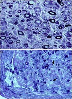 Patología en el SGB fulminante con inexcitabilidad precoz de los nervios69. A)Sección semifina de L5A en la que se observa una desmielinización masiva con numerosos macrófagos repletos de gotitas de grasa. B)Sección semifina del nervio crural en la que se observan numerosas fibras con colapso de la mielina (asteriscos), lo cual es indicativo de degeneración axonal activa, y axones desmielinizados (flechas). Nótese de nuevo la presencia de macrófagos repletos de gotitas de grasa, a menudo rodeando fibras con mielina colapsada (azul de toulidina, ×630 antes de reducción).