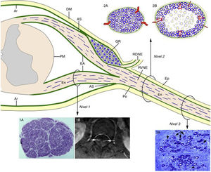 Diagrama de la anatomía microscópica de la médula espinal, raíces raquídeas y nervios espinales según Berciano et al.16. A partir del ángulo subaracnoideo (AS), el epineuro (Ep) está en continuidad con la duramadre (DM). El endoneuro (En) de los troncos nerviosos periféricos se prolonga por las raíces hasta su unión con la médula espinal. En el AS, gran parte del perineuro (Pe) se incorpora a la aracnoides subdural (Ar), pero unas pocas capas forman la envoltura aracnoidea (EA) de las raíces espinales. La Ar radicular se continúa con la piamadre (PM) en su emergencia de la médula espinal. Inmediatamente después del ganglio espinal raquídeo (GR), en el AS, las raíces ventrales y dorsales se unen para formar el nervio espinal, que emerge por el agujero vertebral dividiéndose en un ramo dorsal (RDNE) y otro ventral (RVNE). Consecuentemente, las raíces raquídeas intratecales poseen una envoltura laxa derivada de la aracnoides, mientras que la de los nervios espinales y de los troncos nerviosos más distantes consta de epi-perineuro que es relativamente inelástica. Las lesiones inflamatorias próximo-distales en la fase precoz del SGB se ilustran del siguiente modo: raíz ventral lumbar (Nivel 1), nervio espinal (Nivel 2) y nervio ciático (Nivel 3). En el Nivel 1, esta sección semifina transversa completa de la raíz L5, en un caso de SGB fatal, demuestra preservación de la densidad de fibras mielinizadas (1A), aunque las lesiones inflamatorias observables a mayor aumento (no mostradas) pueden justificar el incremento del área transversa, y su engrosamiento y realce tras la administración de contraste en el examen de resonancia magnética (1B, flechas). Los dos dibujos del Nivel 2 ilustran los siguientes hechos: a)anatomía normal de un nervio espinal, usualmente monofascicular, con sus vasos transperineurales y su envoltura epi-perineural (2A), que justifican su aspecto ultrasonográfico normal caracterizado por una estructura redondeada u ovalada hipoecoica con un anillo periférico hipercoico (ver texto más adelante), y b)en la fase precoz del SGB el edema inflamatorio endoneural puede provocar una elevación crítica de la presión endoneural en los nervios espinales, que tensa el epi-perineuro más allá de su compliancia constriñendo los vasos transperineurales, lo cual conduce a la isquemia endoneural, aquí centrofascicular (2B). El Nivel 3 corresponde a una sección semifina de nervio ciático en un caso de AIDP fatal, donde se observan varias fibras con degeneración axonal (colapso de la mielina, flechas), que aquí es fenómeno secundario a lesiones desmielinizantes inflamatorias más proximales; nótese también la presencia de fibras remielinizadas (puntas de flecha) y de macrófagos repletos de grasa. Sin conocer la existencia de una patología desmielinizante proximal, hubiera sido muy difícil interpretar fidedignamente el papel patogénico de la florida patología axonal observada en esta imagen. Diagrama inspirado por la figura 2-6 del trabajo de Berthold y colaboradores68.