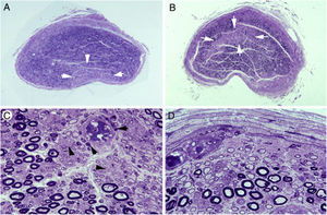 Lesiones isquémicas en troncos nerviosos proximales en la AIDP70.A)Sección transversa semifina del tercer nervio lumbar en la que se observa un área en cuña (flechas) con acusada pérdida de fibras mielínicas (azul de toluidina; ×62 antes de reducción). B)Sección transversa semifina del tronco lumbosacro en la que hay un área centrofascicular (flechas) con pérdida de fibras mielínicas (azul de toluidina; ×62 antes de reducción). Tanto en A como en B, nótese una reducción difusa de la densidad de fibras mielínicas. C)Detalle de la región centrofascicular del tronco lumbosacro a más aumento, donde se observa una acusada pérdida de fibras mielínicas gruesas, pequeños axones finamente mielinizados, axonales amielínicos preservados (puntas de flecha) y numerosas células inflamatorias mononucleares, algunas con distribución perivascular (flechas) (azul de toluidina; ×375 antes de reducción). D)En esta región subperineural del tronco lumbosacro, obsérvese numerosas fibras des-remielinizadas y numerosas células mononucleares; tan extensa des-remielinización justifica, en buena medida, la aparente pérdida de fibras mielinizadas en A y B (azul de toluidina; ×475 antes de reducción).
