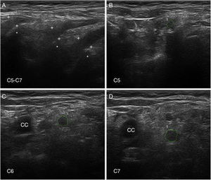 Ultrasonografía (US) de nervios cervicales en la AIDP (mismo caso de la figuras 2 y 3); para hallazgos histológicos en el sexto nervio cervical, ver figura 1 y S1 en la referencia de Gallardo et al.15. A)Sonograma sagital en el que se observa un borramiento de la envoltura epineural de los tres nervios escaneados (calibradores señalados con cruces). Los asteriscos indican las apófisis vertebrales transversas. B-D)Sonogramas de los ejes cortos de los ramos ventrales de los nervios C5-C7, que han sido delimitados por trazos interrumpidos verdes. Las áreas seccionales transversas estaban significativamente incrementadas. Nótese la ausencia del anillo hiperecoico epineural, lo cual puede contrastarse con las imágenes normales en el trabajo de Haun et al.94. El edema inflamatorio endoneural (ver figs. 2C-D y 3) justifica el incremento del área seccional transversa, mientras que el componente inflamatorio epi-perineural (ver fig. 2E) responde del borramiento del anillo hiperecoico epineural.