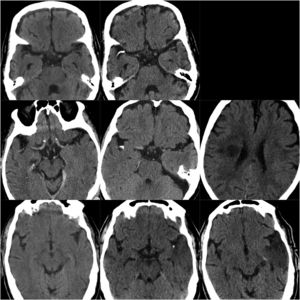 TC de las ECC de los pacientes 1-3. En la primera columna se muestran las TC previas a la ECC; la segunda columna muestra las imágenes de la ECC y la tercera columna la imagen del infarto cerebral correspondiente (salvo en el primer caso, del que ni disponemos de estudio de control tras la ECC).