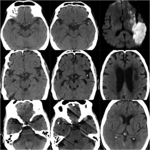 TC de las ECC de los pacientes 4-6. En la primera columna se muestran las TC previas al EC; la segunda columna muestra las imágenes de la ECC y la tercera columna la imagen del infarto cerebral en el territorio correspondiente.