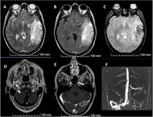 Resonancia cerebral y angio-resonancia. A y B. Hiperintensidad en T2 y Flair compatible con infarto hemorrágico venoso. C. La secuencia de ecogradiante muestra restos de hemosiderina. D y E. La secuencia T1 tras administración de contraste intravenoso muestra obstrucción de vena yugular izquierda y senos venosos izquierdos. F. La angio-resonancia cerebral también muestra trombosis venosa de senos sigmoide y transverso izquierdos y tórcula.