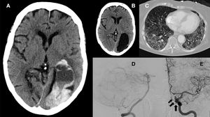 A) TC cerebral: muestra el quiste porencefálico parietooccipital izquierdo con hemorragia (8,5×4×7cm) y ejerce moderado efecto de masa, obliterando los surcos temporales, parietales y occipitales izquierdos y desplazando anteriormente el ventrículo lateral izquierdo. Se observa contenido hemático en el cuerpo y asta temporal del ventrículo lateral izquierdo. Área glioticomalácica occipital paramediana derecha en relación con infarto antiguo en el territorio de la arteria cerebral posterior derecha. B) TC cerebral 3 meses previo a ingreso por COVID-19: muestra quiste porencefálico parietooccipital izquierdo y área glioticomalácica occipital paramediana derecha, sin contenido hemático. C) TC de tórax durante el ingreso: infiltrados en vidrio deslustrado múltiples en ambos hemitórax, más prominentes en regiones de decúbito. D) Arteriografía cerebral con imagen de inyección en arteria vertebral derecha con arteria basilar y cerebrales posteriores de morfología normal. E) Arteriografía cerebral: arteria carótida interna con varios aneurismas que se originan desde porción C4 (señalados por la flecha negra). Uno de ellos de 3,6×3,6mm, cuello de 2,7mm, desde la cara posterior del segmento cavernoso; el segundo de 3,09×1,1mm, cuello de 2,3mm desde la cara postero-lateral del segmento clinoideo; el tercero de 2,5×5,2mm, cuello de 3,7mm, situado en la cara superior del segmento oftálmico.