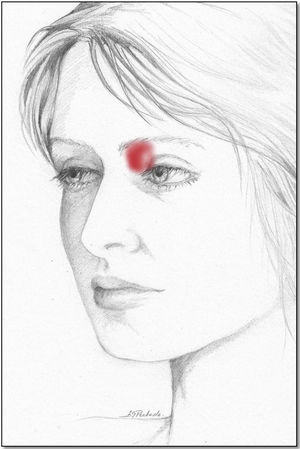 Área de dolor referida por el paciente con afectación de la región troclear.