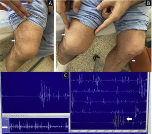 A) Depresión suprarrotuliana bilateral, más evidente en rodilla derecha; B) Amiotrofia en ambos músculos tibiales y cuádriceps, con imposibilidad para extensión de ambas rodillas. C) Electromiografía de aguja en músculo vasto lateral derecho: potenciales de unidad motora pequeños, intercalados con polifásicos, y patrón de esfuerzo máximo reducido.