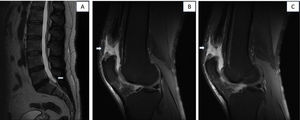 Imágenes de resonancia magnética (corte sagital T2) lumbar y de rodillas: A) Resonancia lumbar, con pequeña protrusión L5-S1, y menor en L4-L5. B) Resonancia de rodilla derecha: rotura del 90% de fibras del tendón cuadricipital. C) Resonancia de rodilla izquierda: rotura completa del tendón cuadricipital.