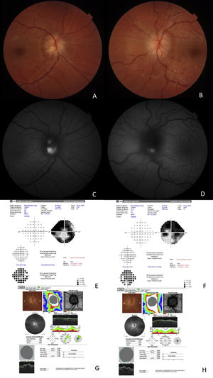 A) Edema de papila del ojo derecho. B) Edema de papila del ojo izquierdo. C) Imagen de autofluorescencia: la hiperfluorescencia indica la presencia de drusas en el ojo derecho. D) Imagen de autofluorescencia: la hiperfluorescencia indica presencia de drusas en el ojo izquierdo. El campo visual del ojo derecho muestra contracción intensa del campo. F) El campo visual del ojo izquierdo muestra contracción intensa del campo. G) La OCT del ojo derecho muestra aumento del grosor de la capa de fibras. H) La OCT del ojo izquierdo muestra aumento del grosor de la capa de fibras.