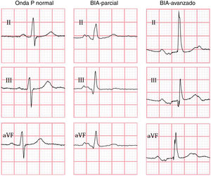 Ejemplos de BIA en comparación con un electrocardiograma con onda P normal. BIA: bloqueo interatrial.
