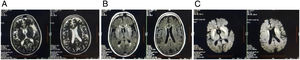 Brain MRI revealing symmetrical altered intensity lesions, hyperintense in axial T2WI (A), axial T2-FLAIR (B), axial-DWI (C) sequences, over bilateral caudate nucleus and putamen, sparing the globus pallidus.
