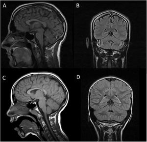 RM cerebral en secuencias T1 corte sagital (imágenes A y C) y FLAIR coronal (imágenes B y D). Las imágenes A y B corresponden al paciente A, mientras que C y D corresponden al paciente P. En ambos casos se objetiva la normalidad de las estructuras troncoencefálicas y cerebelosas, sin signos típicos de hipoplasia pontocerebelosa salvo quizá una mínima atrofia vermiana en el paciente A (imágenes A y B).