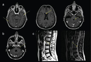 a)RM cerebral axial a distintos niveles en secuencia T1 con contraste donde se observa realce y engrosamiento de la duramadre y leptomeninges, realce periventricular y realce nodular del IVventrículo. b)RM cerebral a nivel de la salida de los nervios craneales en secuencia T1 con contraste donde se observa realce del paquete estato-acústico-facial izquierdo. c)RM medular lumbar, corte sagital, en secuencias T2 y T1 con contraste donde se observa engrosamiento y realce de las raíces de la cola de caballo.