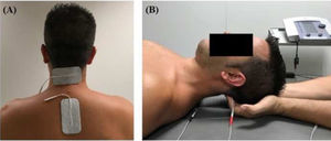 (A) Electrodos adhesivos sobre los músculos suboccipitales. (B) Inhibición muscular suboccipital simultánea y técnica de corriente interferencial.