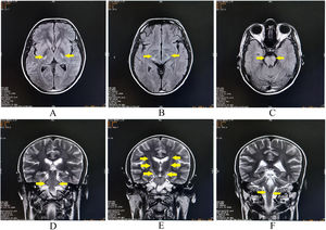 Brain magnetic resonance imaging revealing bilateral symmetrical hyperintense lesions on axial T2-weighted-fluid-attenuated inversion recovery involving posterior limb of internal capsules (A), crus of midbrain (B), and basis pontis (C). The lesions are hyperintense on coronal T2-weighted images at bilateral middle cerebellar peduncles (D), and along the corticospinal tracts from internal capsules to basis pontis (E, F).