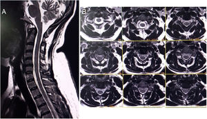 Spinal magnetic resonance imaging. Midsagittal (A) and axial (B) T2-weighted imaging showing no abnormalities in the cervical cord.