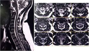 Spinal magnetic resonance imaging. Midsagittal (A) and axial (B) T2-weighted imaging showing no abnormalities in the cervical cord.